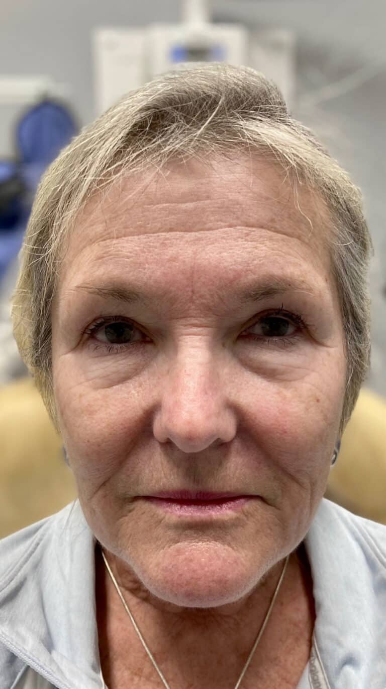 Before Image: Botox - front