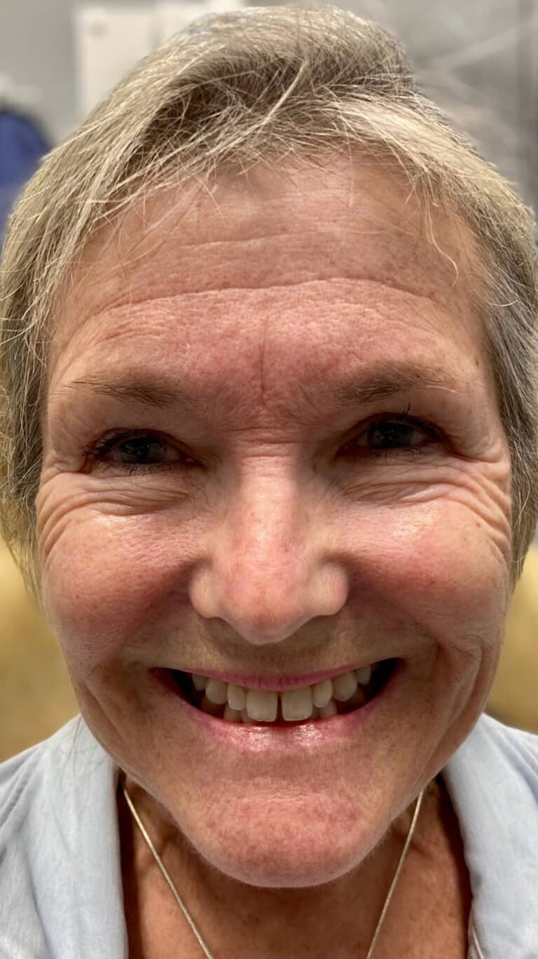 Before Image: Botox - front