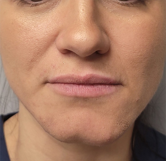 Before Image: Lip Filler - front
